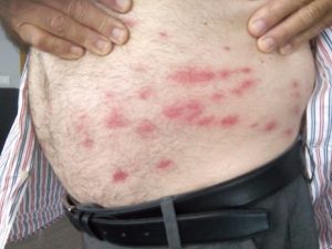 Picaduras de mosca negra en el cuerpo de un agricultor